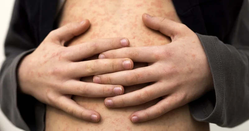 Непривитых от кори детей не будут принимать на плановую госпитализацию в Астане