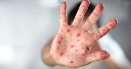 Новые правила: детей в Астане будут госпитализировать только после прививки от кори