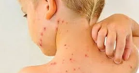 Енді қызылшаға қарсы вакцина міндетті: Астана ауруханаларына бала қабылдау ережесі өзгерді