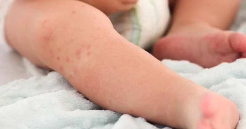 Қазақстанда қызылша өршіп тұр: Денсаулық сақтау министрі ата аналарға үндеу жасады