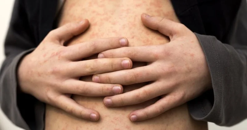 В Астане разрешили госпитализацию детей без прививки от кори