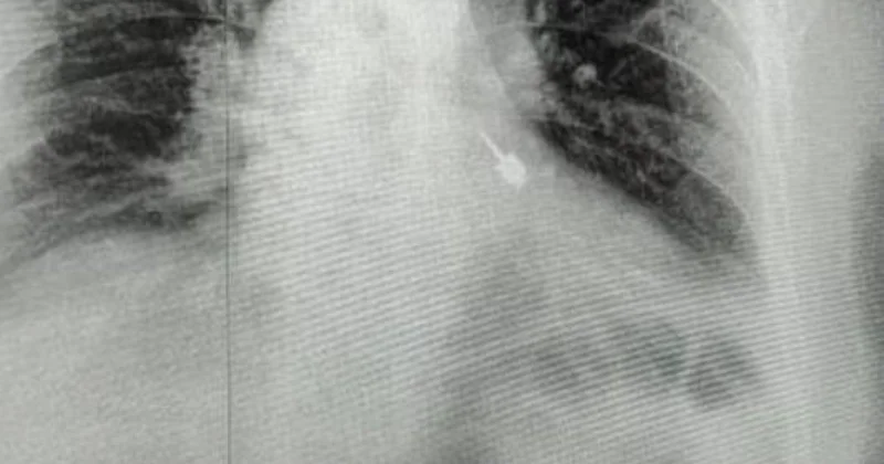 Бур провалился в бронхи пациента во время лечения зубов в России