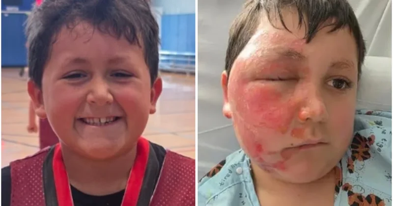 Ребенок получил ожоги лица из за тренда в Tik Tok (ВИДЕО)