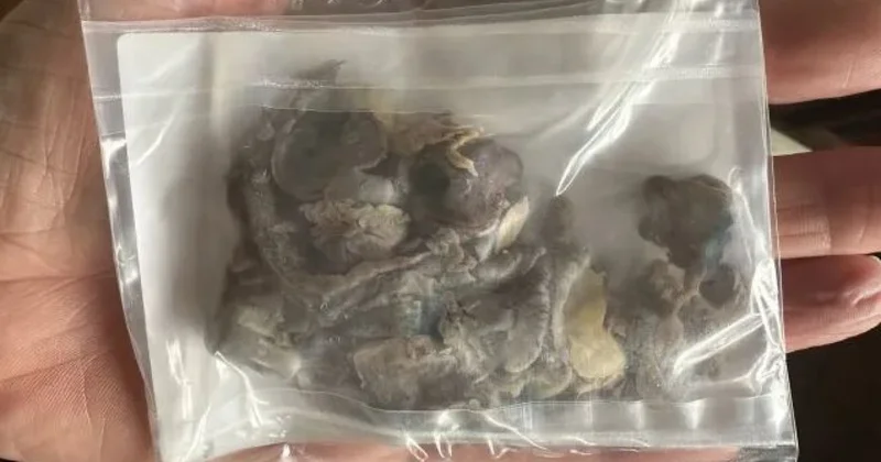 Врачи удалили подростку часть легкого и вернули ее в пакете