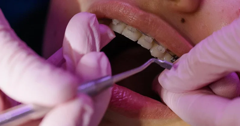 Слухи о бесплатной установке брекетов казахстанским детям прокомментировали в ФСМС