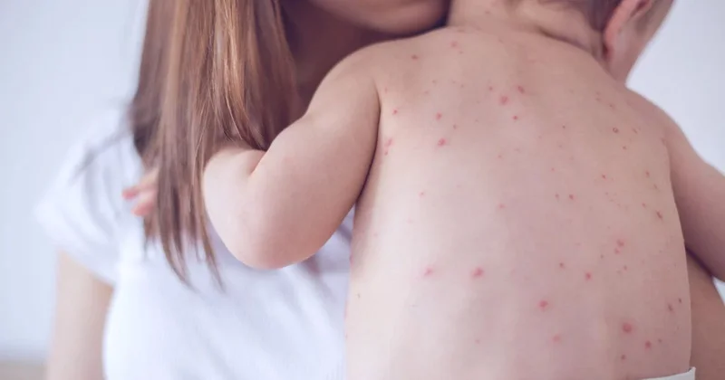 Министрлік дабыл қағуда: Қазақстанда қызылшамен ауыратындар саны 2000 ға жуықтады