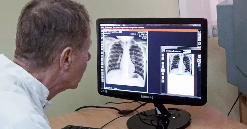 Туберкулез жұқтырғандар саны 10% ға төмендеді