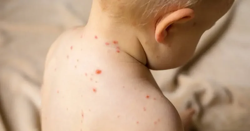 100 детей умерли от кори за месяц в Бангладеш, в стране начали экстренную вакцинацию