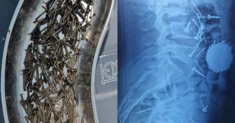 Өзбекстанда дәрігерлер науқастың асқазанынан 200 грамм шеге алып шықты