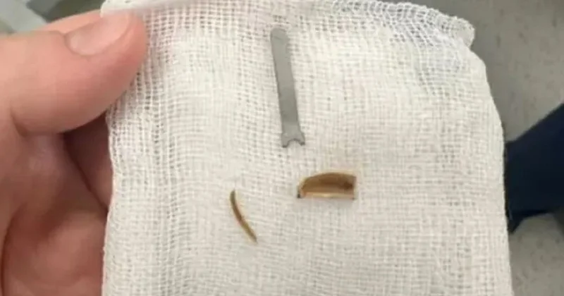 Врачи извлекли металлический предмет из легкого ребенка в Актау: родители думали, что у него астма