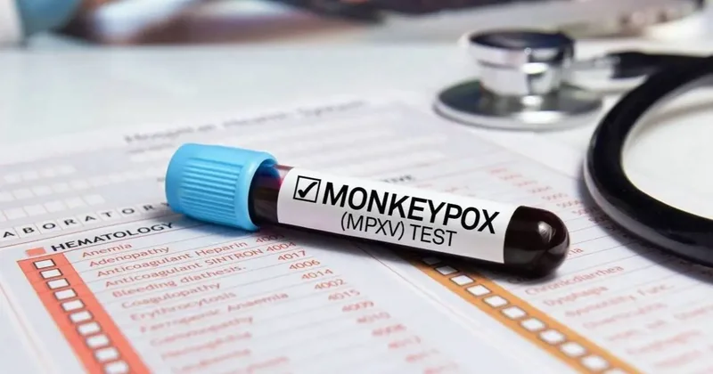 Новый штамм оспы обезьян обнаружили в Великобритании