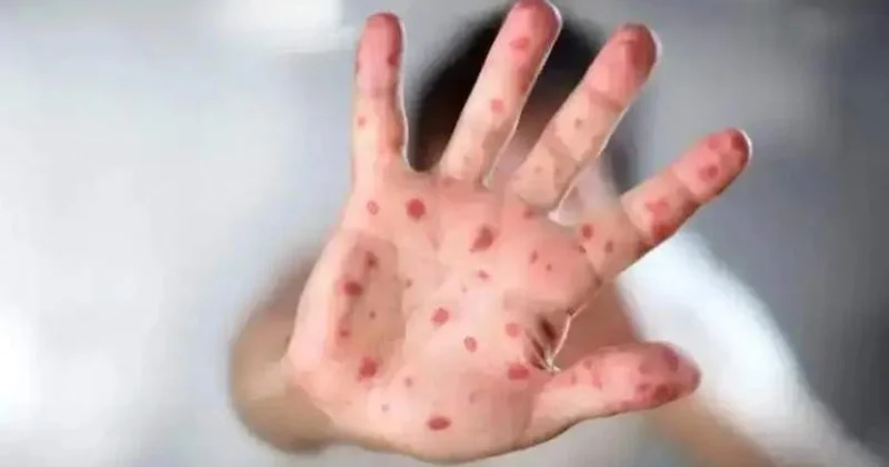 Маңғыстауда қызылша ауруы бойынша эпидемиологиялық жағдай тұрақсыз