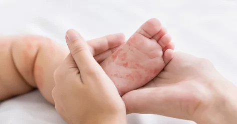 Более 130 случаев заболевания корью выявлено в Мангистау