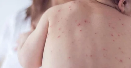 59% детей не получили прививки от кори по решению родителей в РК