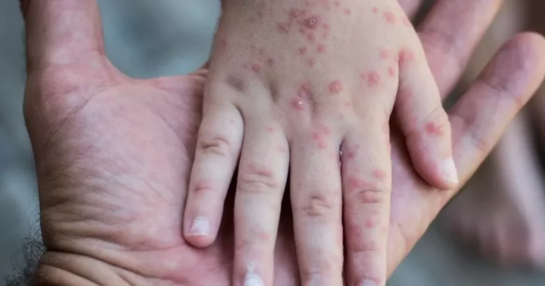 Основная доля заболевших корью в Казахстане приходится на детей до пяти лет Аналитический интернет журнал Власть