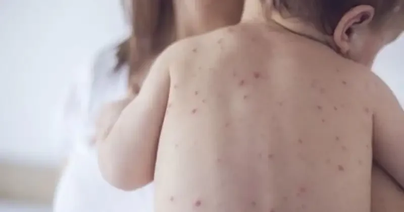 Балаларды қызылшадан қалай қорғау керек? Дәрігер кеңесіне назар аударыңыз