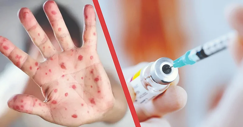 Елімізде қызылшаға қарсы вакцинация науқаны тоқтады ма?