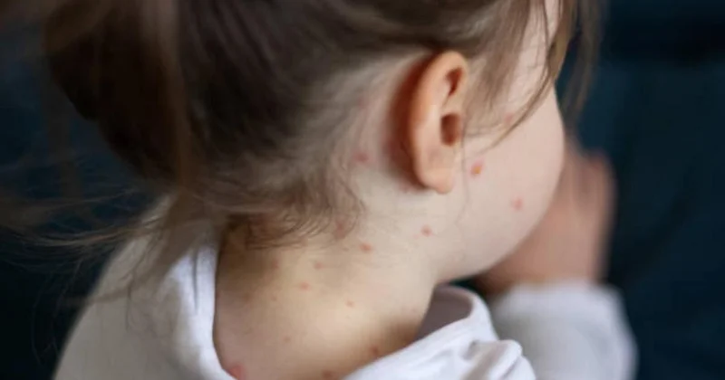 Заболеваемость корью резко выросла в Жамбылской области