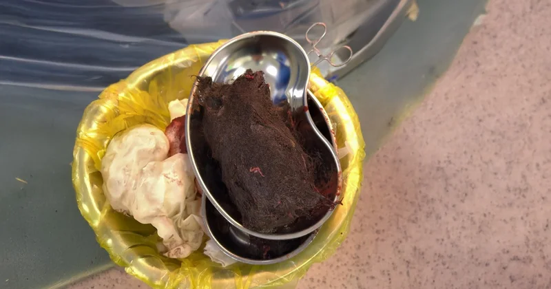 Түркістан облысында 15 жастағы қыздың асқазанынан 1 келі шаш алынды