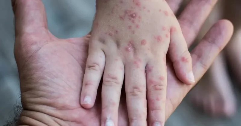 Атырауда қызылша жұқтырған 290 науқас емделіп жатыр