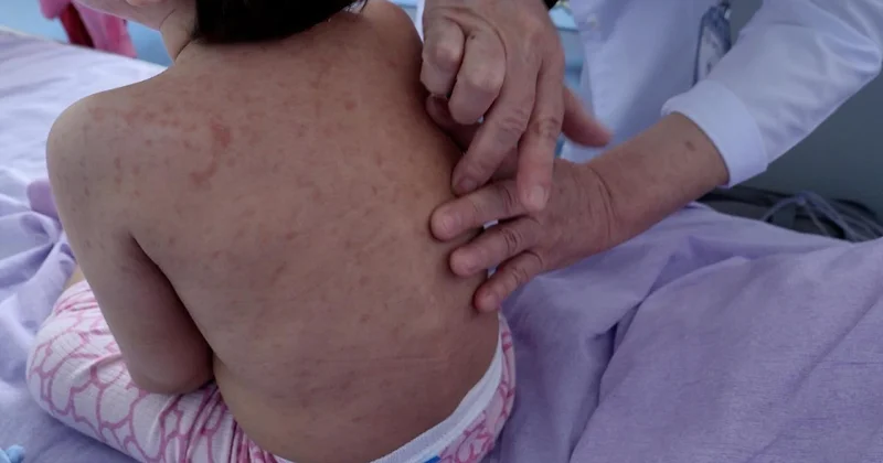 Елімізде қызылша жұқтыру көрсеткіші 30% ға төмендеді