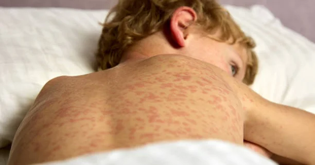 Батыс Қазақстанда қызылша дерті өршіп тұр