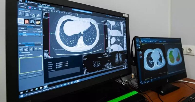 Қазақстанда өкпе обырын ерте анықтайтын скринингтің жаңа түрі пайда болады