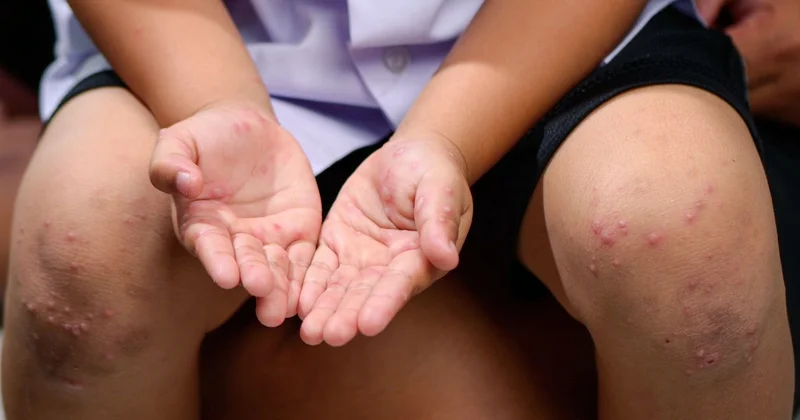 Вспышка кори в Казахстане: кому категорически нельзя ходить в школу и детсад