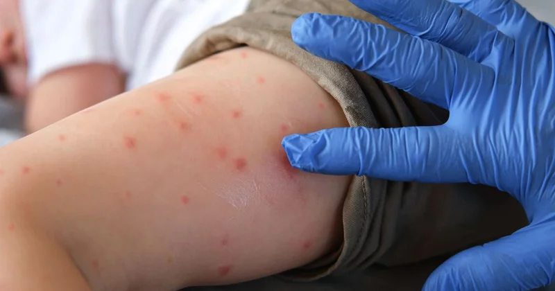 Отстранение непривитых : новые меры из за вспышки кори ввела главный санврач Казахстана