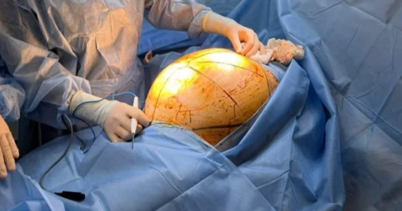 Алматинке удалили 25 килограммовую опухоль после приема БАДов