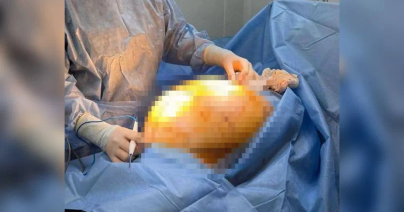 Алматы: Дәрігерлер 25 келілік ісігі бар әйелді аман алып қалды