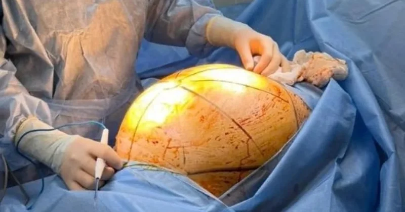 Казахстанка лечилась БАДами и довела опухоль до 25 кг