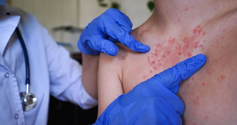 Қызылшаға қарсы екпе алмаған балалар мектепке де, балабақшаға да бармайды