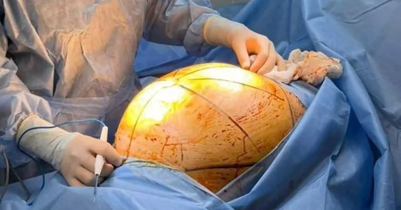 Алматылық дәрігерлер науқастың ішінен салмағы 25 кг тартатын ісік алды