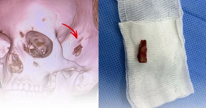 Мальчик пять лет прожил с куском ветки в голове в Павлодаре