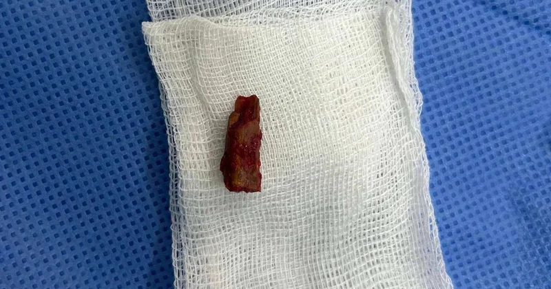 Павлодар облысында жеткіншек басына кіріп кеткен ағашпен бес жыл жүрген