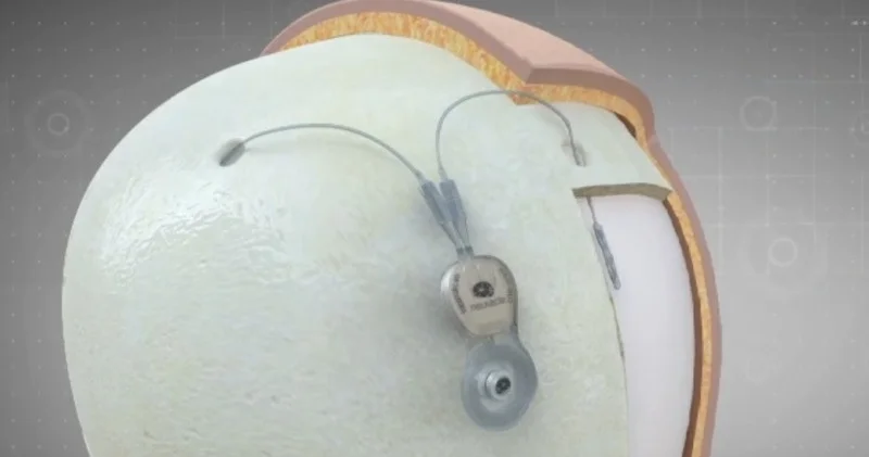 Қытай мидан сигнал жинайтын әлемдегі алғашқы инвазивті өнімді саудаға шығарады