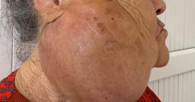 Алматыда 10 жыл бойы ісікпен жүрген әйелге күрделі ота жасалды