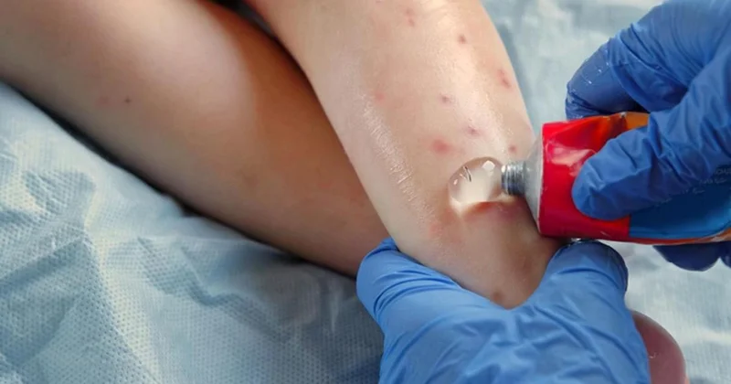 Всего один случай : в акимате Шымкента опровергли информацию о вспышке кори в городе