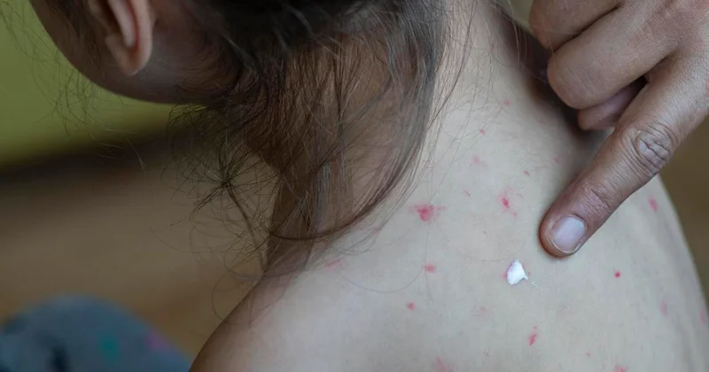 Заболеваемость корью вновь растет в Казахстане: возобновлена дополнительная вакцинация