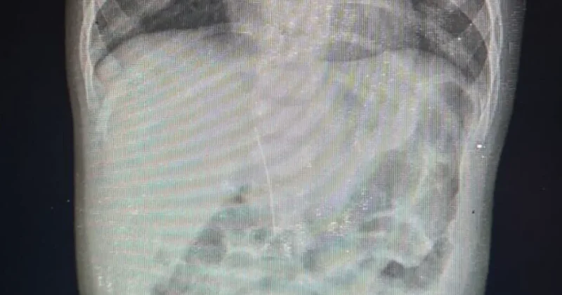 Иглу нашли в брюшной полости младенца в Туркестане