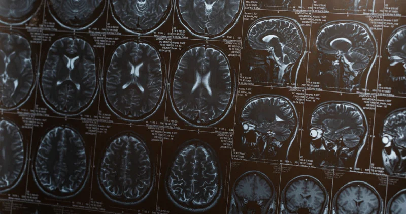 Деменция қаупін едәуір төмендететін қарапайым әдет аталды