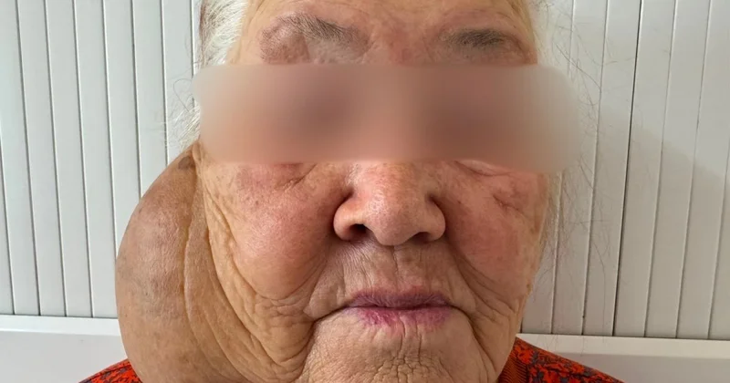 Огромную опухоль удалили хирурги с шеи жительницы Алматинской области