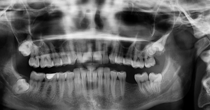 Стоматологи обнаружили пулю в челюсти пациентки из Караганды