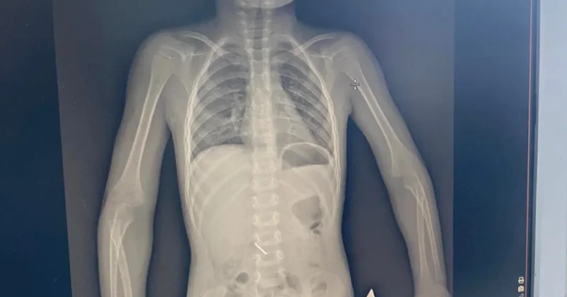 В Кокшетау трехлетняя девочка проглотила инструмент на приеме у стоматолога