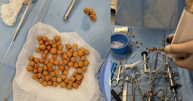 80 камней удалили из мочевого пузыря пациента в Туркестане