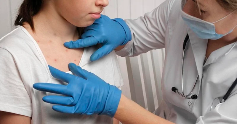 Акимат Астаны обратился к жителям в связи с заболеваемостью корью