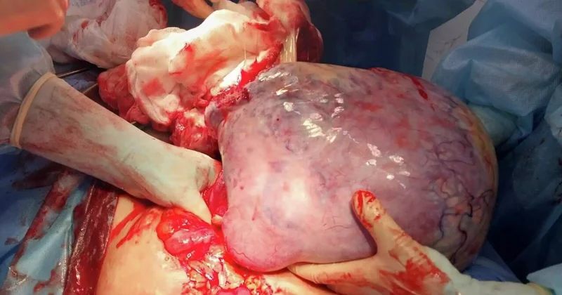 Абай облысында дәрігерлер науқастың ішінен 6 кг ісікті алып тастады