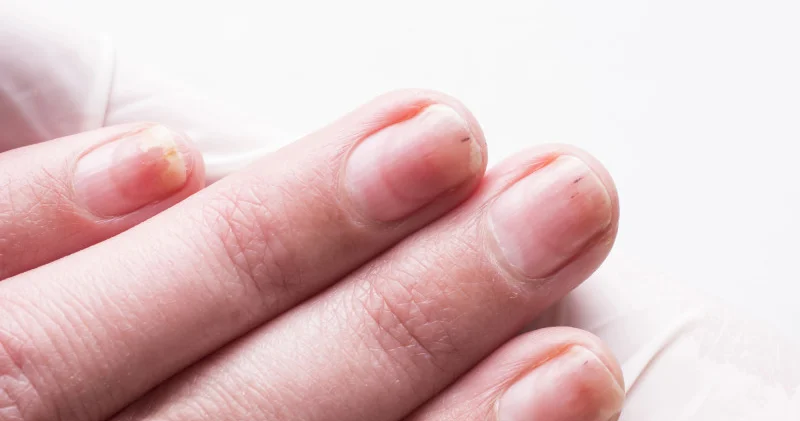 Дәрігерлер бірден байқалатын қатерлі ісік белгілерін атады