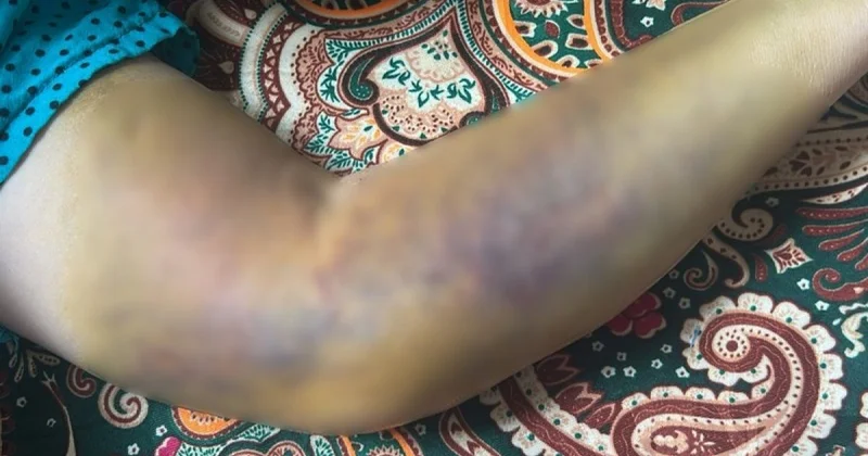 Скандал в больнице Актау: после капельницы рука женщины перестала работать